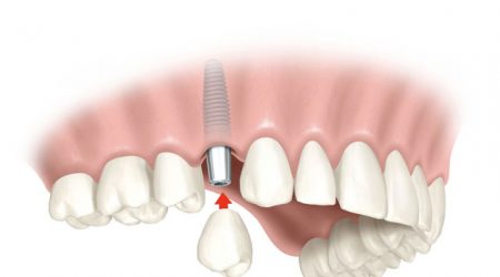 Tratamiento con corona sobre implante en centro odontológico H&M